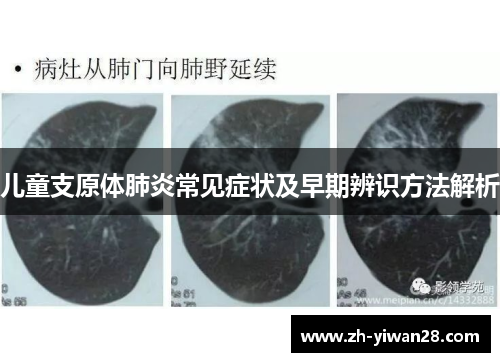 儿童支原体肺炎常见症状及早期辨识方法解析 儿童支原体肺炎常见症状及早期辨识方法解析